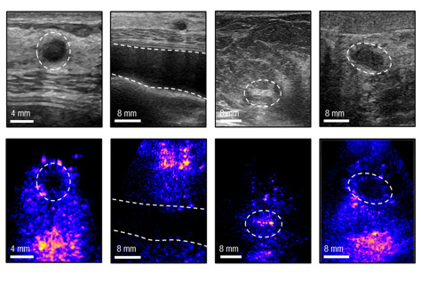Caption: Four views of vivo ultrasound images show, from left to right: a cyst; breast implant; dense fibrous tissue; and solid mass. The top row shows the conventional 2D ultrasound images while the bottom row shows the corresponding 3D images, allowing for easier detection.