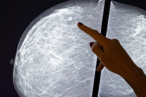 finger pointing at a mammogram