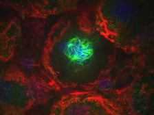 a chaotically dividing cells surrounded by liver tissue