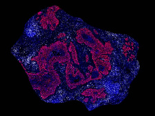 an irregular blob of patient cancer cells, with patches of blue and magenta representing different genetic features