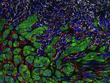 microscopic image of breast cancer cells interacting with immune cells