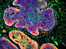 tumor cells invading an acidic environment