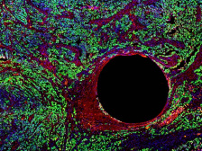 Fluorescent labeled tumor tissue with a large hole 