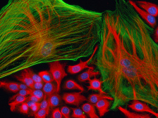 microscopic image of fibroblasts in a lung tumor