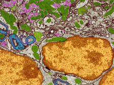 breast cancer cells embedded in the brain