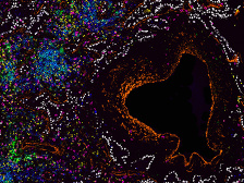 patient sample of lung cancer, with different kinds of T cells labeled in rainbow hues