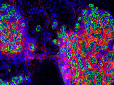 Tumor of the bile ducts, stained in neon hues, surrounded by healthy liver tissue